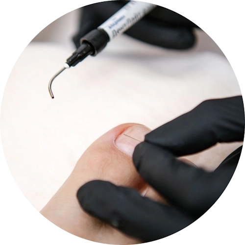 Медицински педикюр